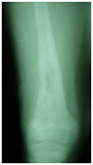 OsteomielitisCronicaRefractaria13