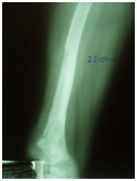 OsteomielitisCronicaRefractaria11