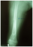 OsteomielitisCronicaRefractaria12