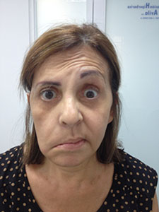 Paralisis Facial Periferica 2