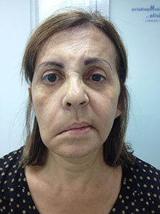Paralisis Facial Periferica 1